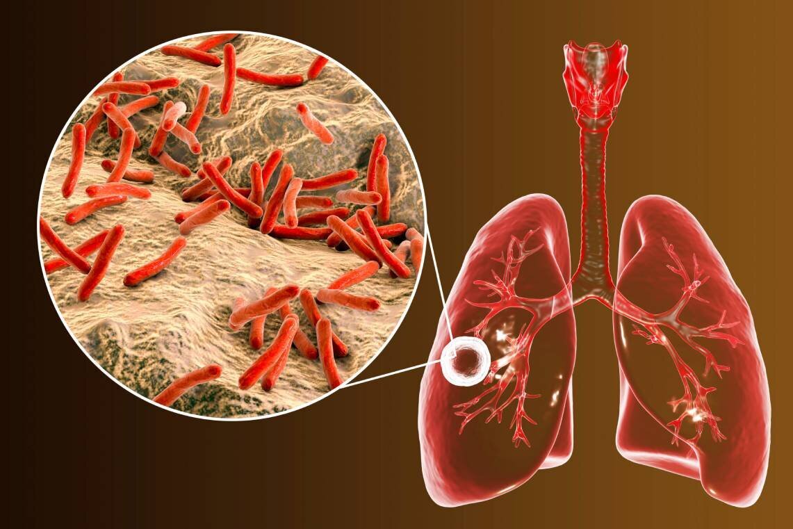 قطع خودسرانه دارو عامل تشدید بیماری سل