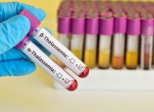 ازدواج دو ناقل به مینور؛ افزایش احتمال ابتلای نسل آینده به تالاسمی ماژور