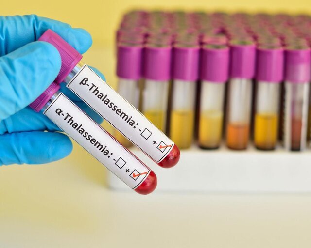 ازدواج دو ناقل به مینور؛ افزایش احتمال ابتلای نسل آینده به تالاسمی ماژور