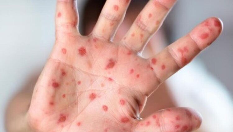 افزایش موارد ابتلا به سرخک در خوزستان در ماههای اخیر